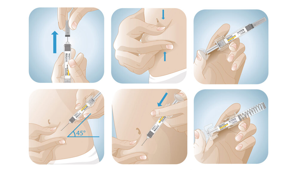 Medizinische Illustration: Verwendung einer Insulinspritze